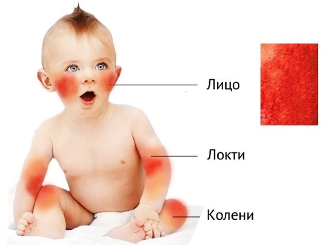 Как определить пищевую аллергию у ребенка